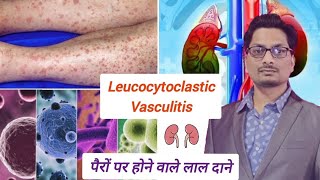 पैरों पर होने वाले लाल दाने  Leucocytoclastic Vasculitis Sudden Red Spots on Leg Palpable Purpura [upl. by Mintun]