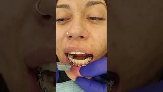 La Increíble Experiencia de Nuestra Paciente Brackets Quitados en Directo saludbucal [upl. by Ssej487]