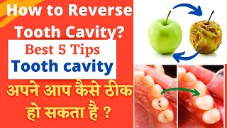 How to Cure Tooth cavity at home in Hindi   Tooth decay घर पर कैसे ठीक हो सकता है [upl. by Adamson799]