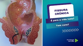 Fissura crônica é para vida toda Como curar uma fissura crônica [upl. by Violeta587]