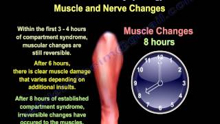 Compartment Syndrome Causes amp Pathophysiology  Everything You Need To Know  Dr Nabil Ebraheim [upl. by Akinom]