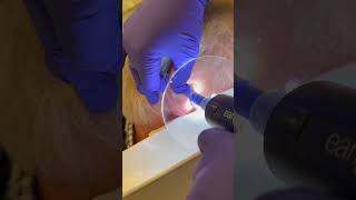 Earwax extraction with earigator 123 earwaxremoval extraction drpimplepopper extractions ears [upl. by Timmie]