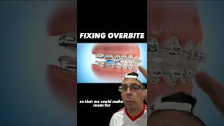 How to Properly Fix an Overbite with Braces  View Mobile Dental shorts [upl. by Odnalro]