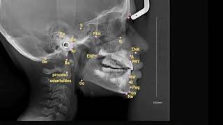 Cephalometric analysis  Tracing  بالعربي [upl. by Eelreveb]