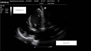 Endocardite Infecciosa  Infective Endocarditis  vegetations on echocardiography [upl. by Aniraad235]