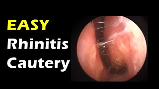 Very Easy Rhinitis treatment simple cautery [upl. by Meares]