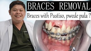 Braces with Pustiso pwede ba TARA at ALAMIN  BRACES REMOVAL  Doc Noy [upl. by Noet]