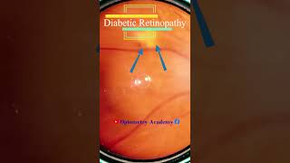 Diabetic retinopathy  cotton wool spots  Fundus  Short Video 172 optometryacademy akleshkumar [upl. by Lovich796]