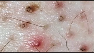 Ingrown Hairs and POPS [upl. by Htevi]