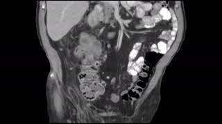 Dedifferentiated liposarcoma mimicking a primary colon mass  CT scan [upl. by Sheree]