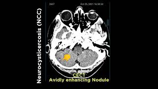 Neuro cysticercosis NCC [upl. by Ayik]