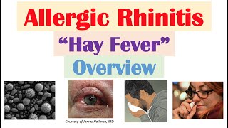 Allergic Rhinitis Hay Fever Risk Factors Pathogenesis Signs and Symptoms Diagnosis Treatment [upl. by Sesiom]