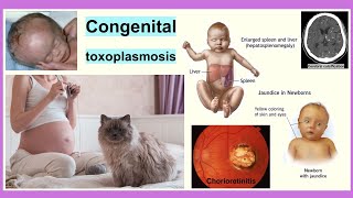 congenital toxoplasmosis [upl. by Danyette]