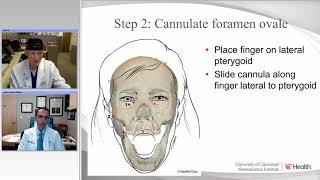 Percutaneous Procedures for Trigeminal Neuralgia Radiofrequency and Balloon Compression Rhizotomy [upl. by Dyanna986]