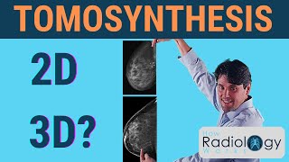 Tomosynthesis Does it offer 3D Mammography [upl. by Kerril]