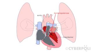 Aortaklepstenose [upl. by Mathian124]