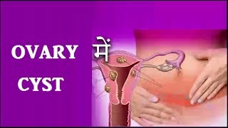 Ovary में Cyst या बच्चे न होना तो करे यह रामबांड उपाय  Ovary Cyst Treatment [upl. by Dualc]