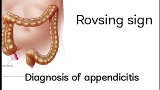 Rovsing sign diagnosis of appendicitisConfirmation of appendicitis Medschool1234 appendicitis [upl. by Samuela]