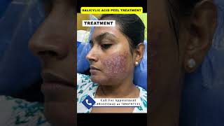 Salicylic acid peel  chemical peel  pimple peeling acne peel druttamkumarlenka acnetreament [upl. by Bowie456]