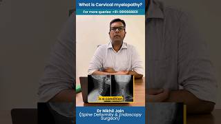 समझे Cervical Myelopathy और उसका इलाज ytshorts spinesurgeon delhi spine [upl. by Suzetta]