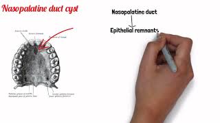 FISSURAL CYSTS  ORAL PATHOLOGY [upl. by Alia6]