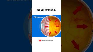 What is Glaucoma 👁️ [upl. by Amat]