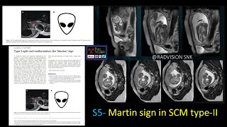 SIGNS IN RADIOLOGYSET IV [upl. by Wei]