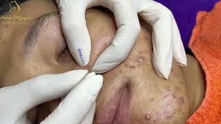 Loan Nguyen Acne Treatment 50b [upl. by Atiral]