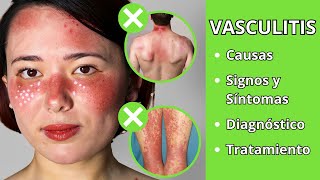 VASCULITIS  Causas signos y síntomas diagnóstico y tratamiento [upl. by Etak]