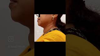 Large thyroid goitre treatment by Radiofrequency ablation RFA [upl. by Elsey955]