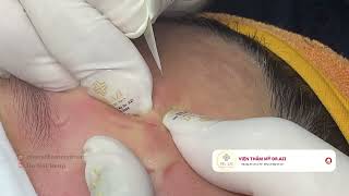 Satisfying Relaxing with Vien Tham My DrAZI vienthammydrazi0058 acne pimples [upl. by Eilama469]