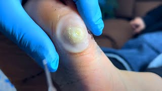 Safe treatment of plantar warts on the side of the feet【Foot Scalpel】 [upl. by Griffin253]