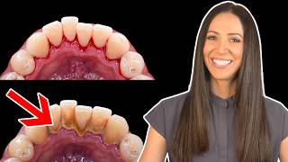 How To Remove Difficult Calculus as a Dental Hygienist [upl. by Ahsinam580]