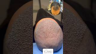 Hair transplant post op for a Norwood 3 without crown hairloss vincihairclinic shorts [upl. by Abey]