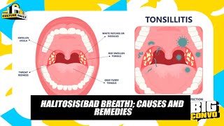 Halitosis Causes Effects And It’s Treatment [upl. by Mcadams]