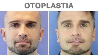 Otoplastia antes y después  Testimonio de David [upl. by Wakefield]