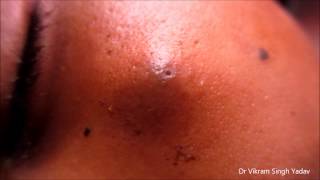 Big Infected Sebaceous Cyst Face [upl. by Ernst]