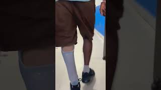 Below knee Prosthetic leg with silicone liner lock and carbon foot [upl. by Atte]