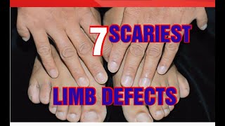 OMG 7 Scariest congenital birth defects you should know [upl. by Donell]