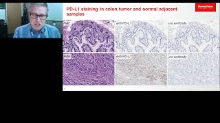 Verifying immunooncologyrelated gene expression patterns in colon tumor research samples [upl. by Abercromby476]