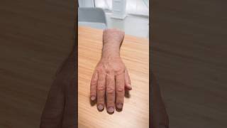 Silicone Hand Prosthesis Fit luxmed prosthesisfit prosthetics silicone siliconehand [upl. by Arahset]