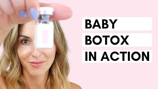 Baby Botox  Using a Dermastamp for Microneedling [upl. by Franzoni]