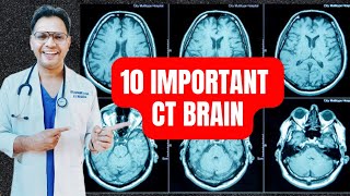 10 Important CT Brain radiology neuroradiology [upl. by Remat]