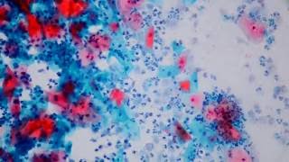 016 Trichomonas vaginalis Conventional Cervicovaginal Cytology [upl. by Eterg]