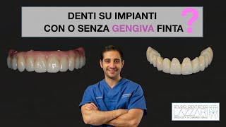 Denti su impianti con o senza gengiva finta [upl. by Eleahcim355]