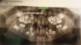 Mixed dentition eruption of permanent and shedding of primary teeth Age estimation by an OPG [upl. by Enneiviv]