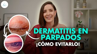 🔴 DERMATITIS en los PARPADOS ¿QUÉ ES y COMO SE CURA drapilarochoa  Dermatologa [upl. by Hetti]