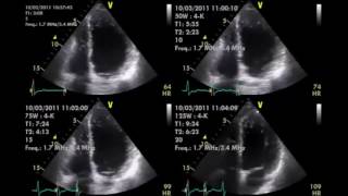 Stressechokardiographie [upl. by Nilats]