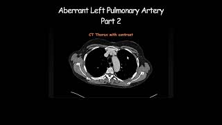 Aberrant Left Pulmonary Artery Part 2 radiology radiologist anatomy [upl. by Brawner]