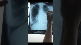 Chest XrayPneumothorax ē Cardiomegaly [upl. by Odnama174]